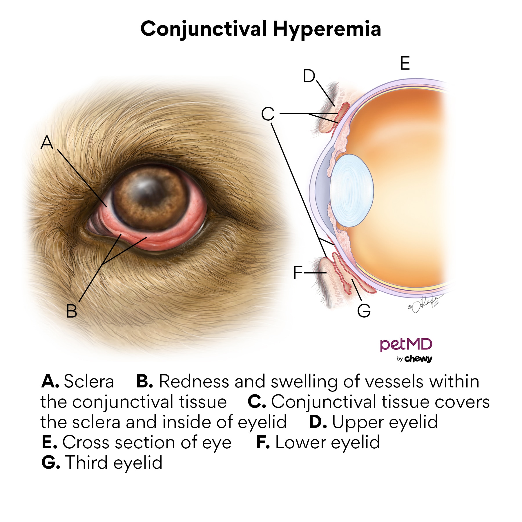 Conjunctival hyperemia