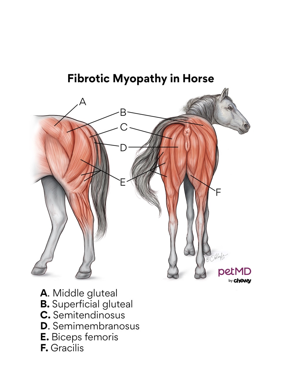 Fibrotic myopathy