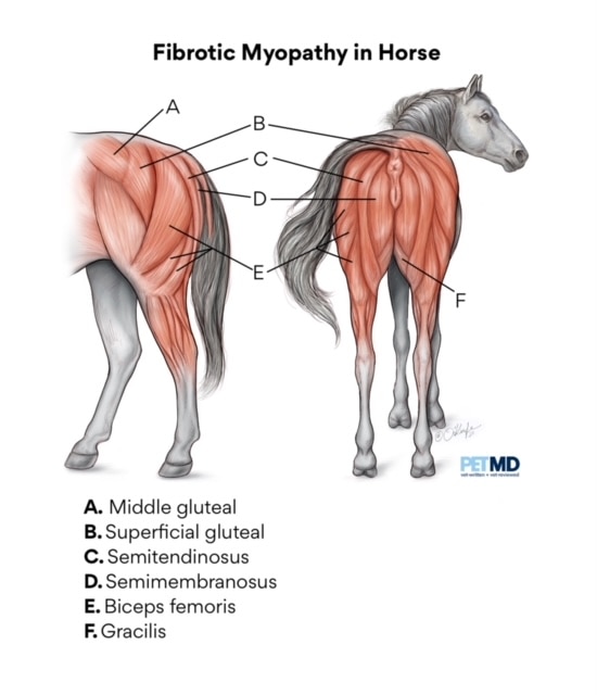 Fibrotic myopathy