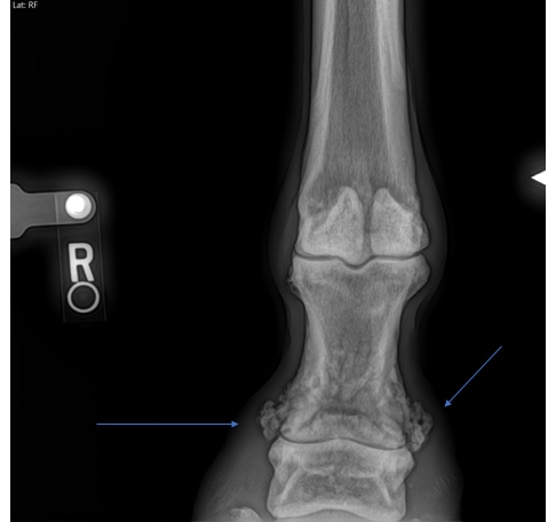 X-ray of a horse affected by high ringbone. The arrows are pointing at the excessive bone growth on either side of the joint.