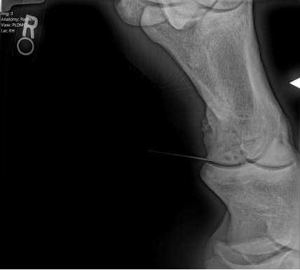 Here is an image of an intra-articular joint injection. The bright white line is a needle inserted into the pastern joint and radiographed to confirm placement for injection.
